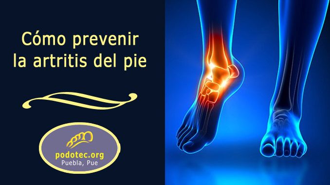 prevenir la artritis del pie